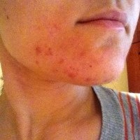 подкожный клещ демодикоз подкожный клещ демодикоз