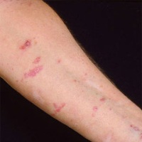 проявление розового лишая проявление розового лишая